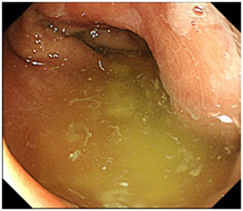 大腸内視鏡検査はどんな姿勢で受ける？きれいにならない対処と苦痛が少ない治療法
