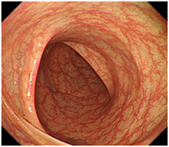 大腸内視鏡検査はどんな姿勢で受ける？きれいにならない対処と苦痛が少ない治療法