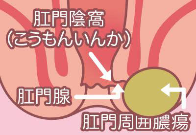 痔瘻の放置はNG？切開開放術から再発予防まで完全治療ガイド