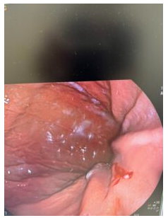 イカのアニサキスで激痛を発症？腹痛・下痢の症状と緊急の治療体験談