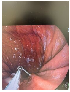 イカのアニサキスで激痛を発症？腹痛・下痢の症状と緊急の治療体験談