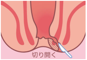 痔瘻の放置はNG？切開開放術から再発予防まで完全治療ガイド